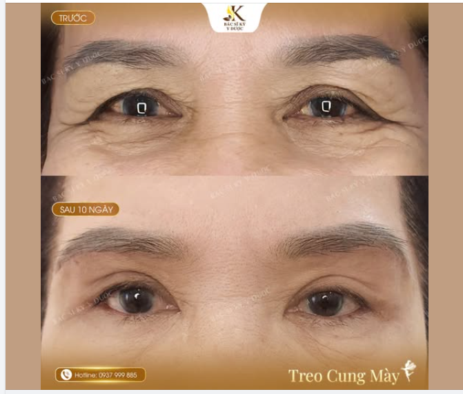 Không chỉ là làm đẹp, mà còn giúp cải thiện tầm nhìn
