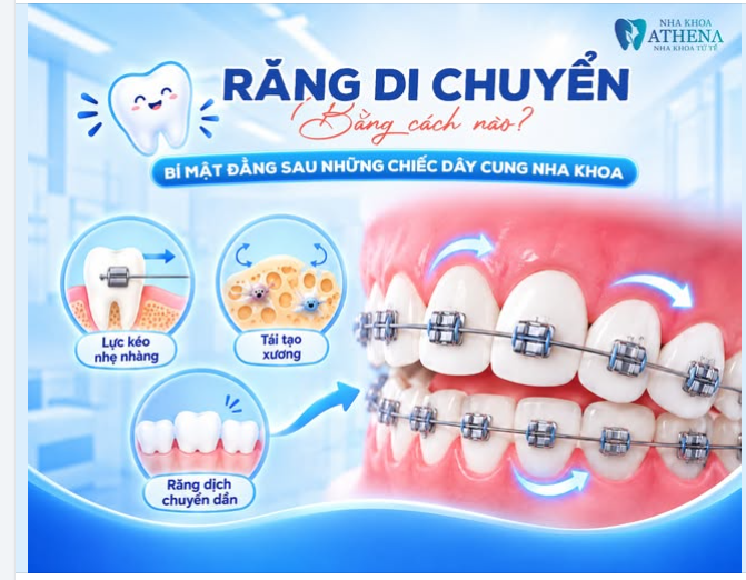 RĂNG DI CHUYỂN BẰNG CÁCH NÀO? BÍ MẬT ĐẰNG SAU NHỮNG CHIẾC DÂY CUNG