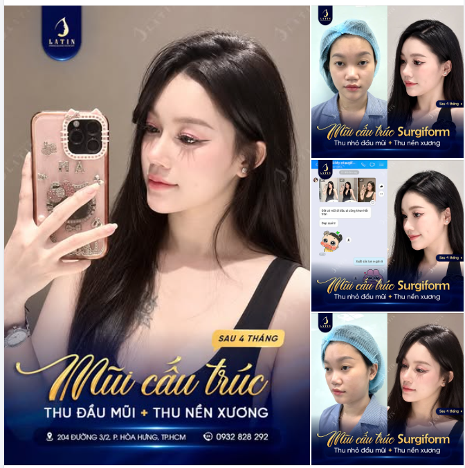 ĐẦU MŨI TO, NỀN MŨI RỘNG – THU GỌN ĐƯỜNG NÉT, DÁNG MŨI CAO BAY SAU 4 THÁNG