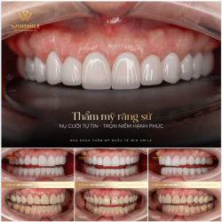 Đã từng làm răng sứ, nhưng nữ khách hàng đến từ Úc vẫn cảm thấy nụ cười ấy chưa thực sự trọn vẹn và thể hiện được cá tính của mình