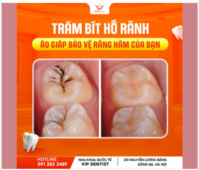 TRÁM BÍT HỐ RÃNH - "ÁO GIÁP" BẢO VỆ RĂNG HÀM TỪ SỚM!