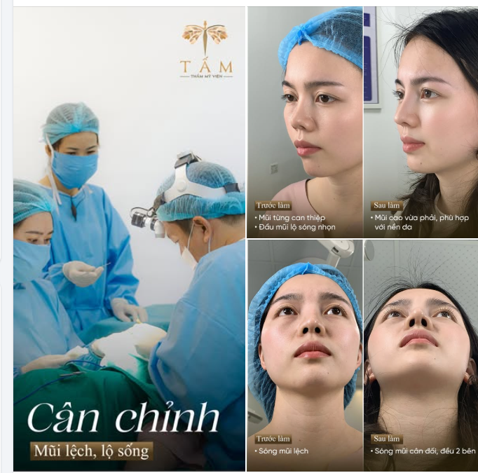 SỬA LẠI MŨI MŨI HỎNG LỆCH - THAY ĐỔI NGOẠN MỤC SAU NHỮNG LẦN CHƯA NHƯ Ý