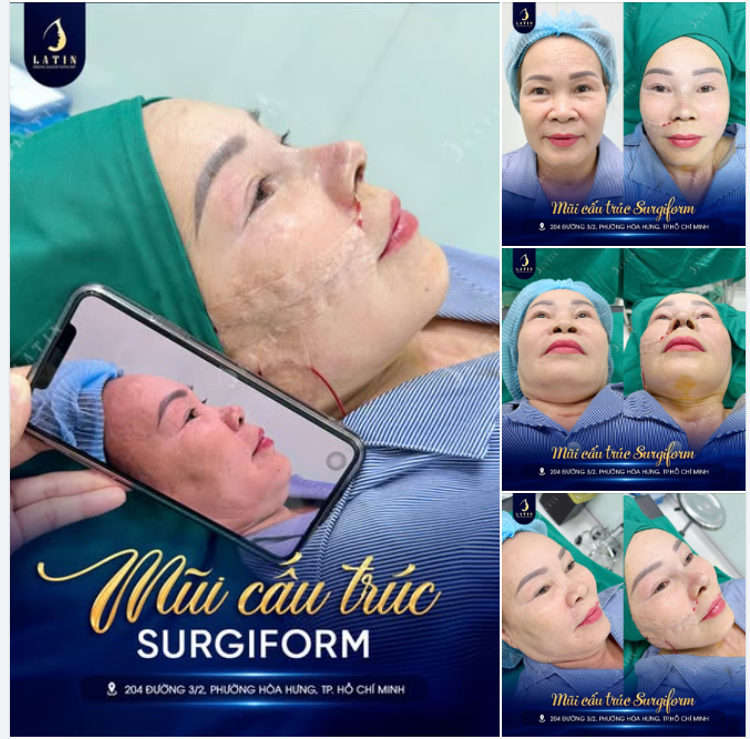 TÁI LẬP CẤU TRÚC MŨI SURGIFORM — ĐỊNH HÌNH DIỆN MẠO ĐA CHIỀU