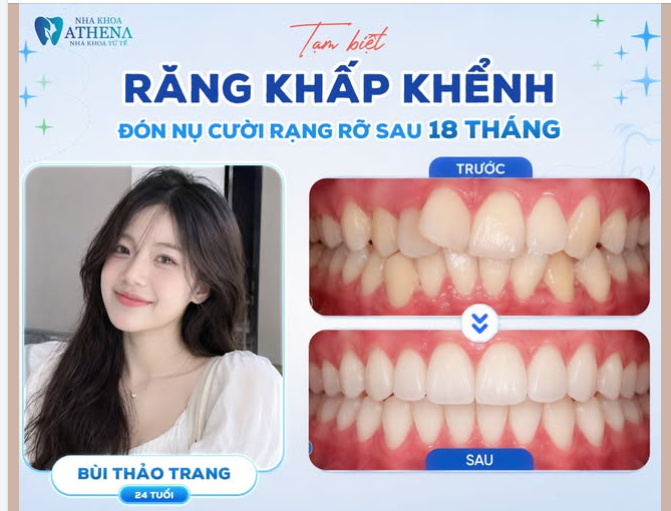 BẠN ĐÃ TỪNG PHẢI TẬP CƯỜI MÍM MÔI, HAY VÔ THỨC LẤY TAY CHE MIỆNG KHI LỠ CƯỜI QUÁ ĐÀ?