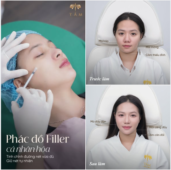 VISUAL SANG TRANG VỚI PHÁC ĐỒ FILLER CÁ NHÂN HÓA