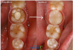 SAU CHỮA TỦY - ĐỪNG QUÊN BẢO VỆ RĂNG