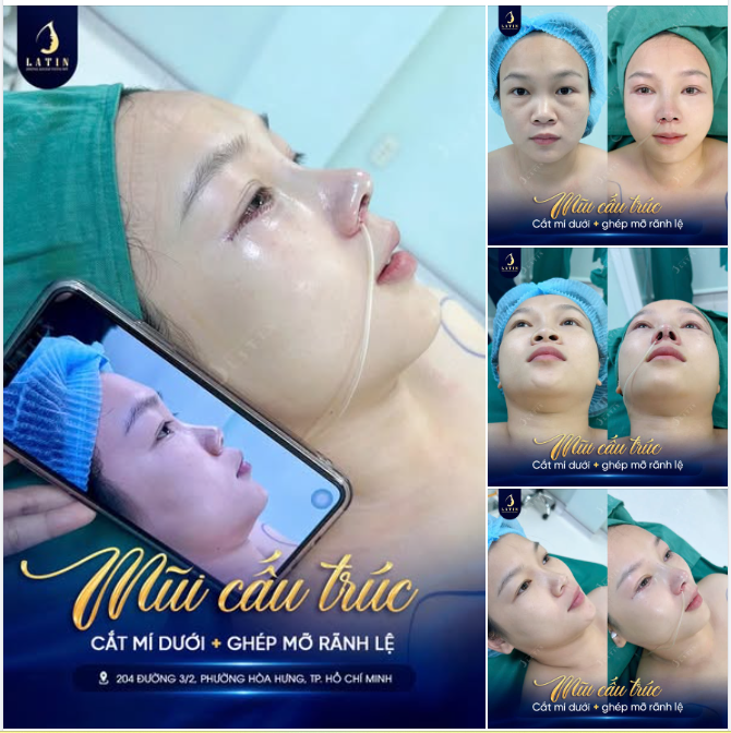 COMBO NÂNG MŨI + TRẺ HÓA M.I DƯỚI — TẠO ĐƯỜNG NÉT VÀ XÓA BỎ DẤU VẾT THỜI GIAN