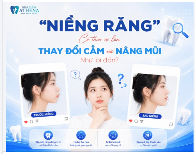 NIỀNG RĂNG CÓ THỰC SỰ LÀM "THAY ĐỔI CẰM" VÀ "NÂNG MŨI" NHƯ LỜI ĐỒN?
