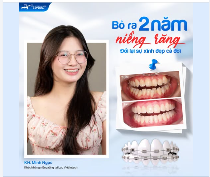 2 NĂM NIỀNG RĂNG - ĐỔI LẠI MỘT NỤ CƯỜI XINH ĐẸP CHO CẢ ĐỜI