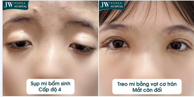 SỤP MI BẨM SINH CÔ GÁI GEN Z ĐƯỢC BÁC SĨ JW CẮT DA, TREO CƠ MẮT TÌM LẠI ÁNH SÁNG SAU 20 NĂM