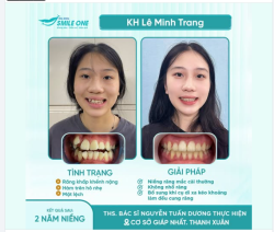 MINH CHỨNG THỰC TẾ HẾT LỆCH MẶT SAU 2 NĂM NIỀNG RĂNG