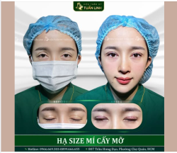 HẠ MÍ KẾT HỢP CẤY MỠ – KHẮC PHỤC MÍ HỎNG, TRẺ HÓA NẾP MÍ