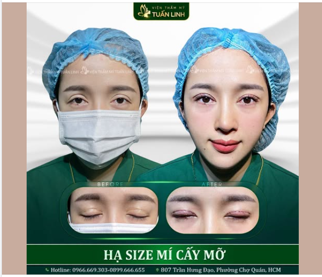 HẠ MÍ KẾT HỢP CẤY MỠ – KHẮC PHỤC MÍ HỎNG, TRẺ HÓA NẾP MÍ