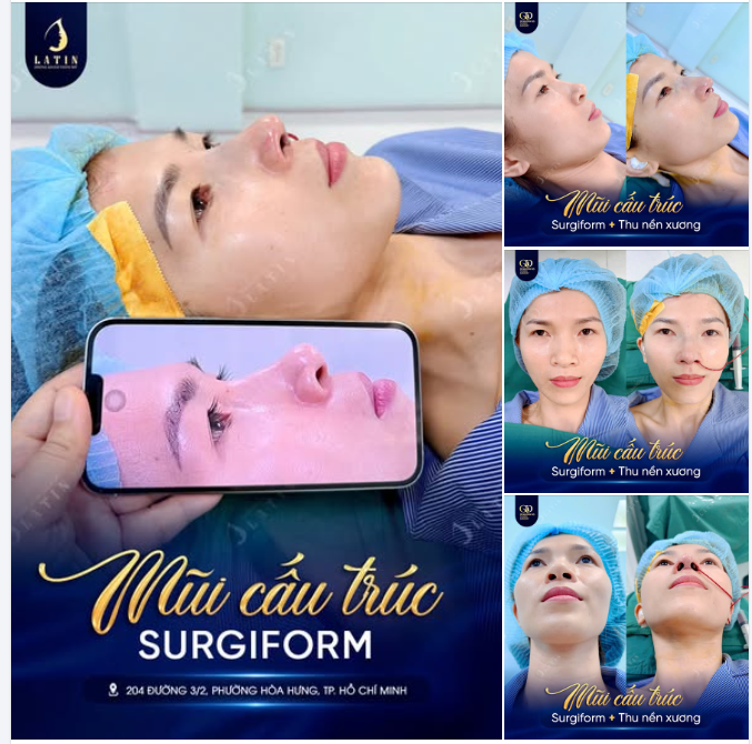 MŨI CẤU TRÚC SURGIFORM: ĐỈNH CAO TẠO HÌNH
