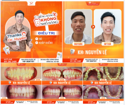NIỀNG RĂNG KỊP THỜI - GIỮ RĂNG ỔN ĐỊNH