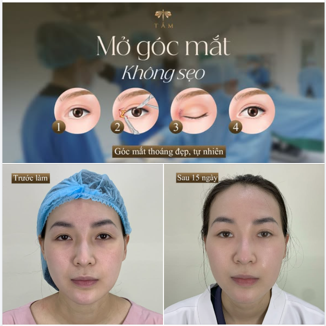 MỞ GÓC MẮT KHÔNG SẸO - MẮT THOÁNG NHẸ TỰ NHIÊN