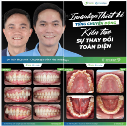 40 TUỔI CÓ CÒN NIỀNG RĂNG ĐƯỢC KHÔNG?  CA INVISALIGN ĐÓNG KHE THƯA DO RĂNG KẸ "TÁI SINH" LẠI NỤ CƯỜI Ở TUỔI U40