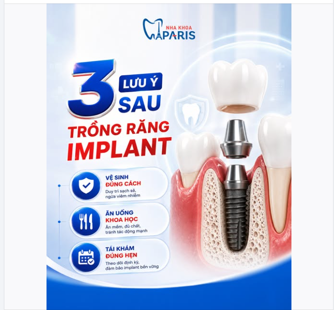 3 LƯU Ý VÀNG SAU KHl TRỒNG RĂNG IMPLANT ĐỂ RĂNG BỀN ĐẸP TRỌN ĐỜI!
