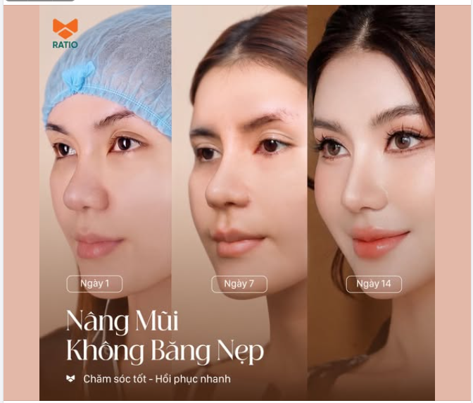 Một dáng mũi hoàn hảo không thể đánh giá ngay trong 24 giờ đầu