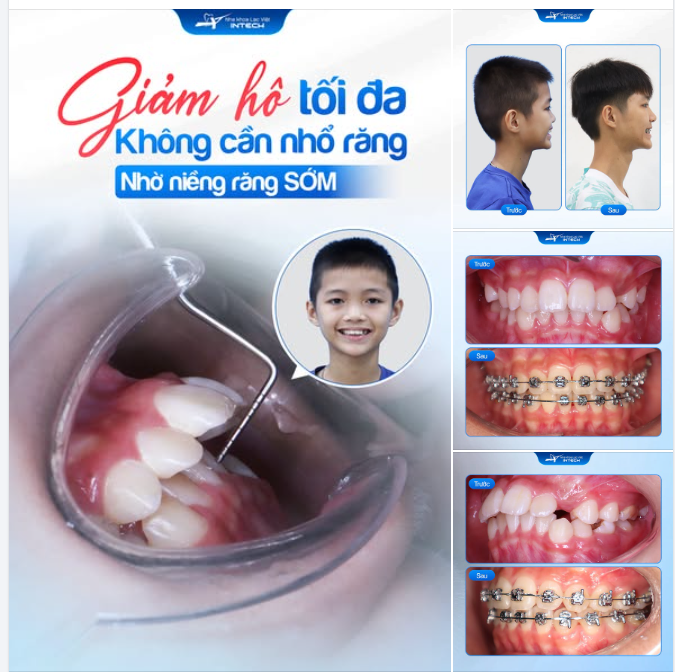 NIỀNG RĂNG SỚM CÓ THỂ GIÚP GIẢM HÔ HIỆU QUẢ MÀ KHÔNG CẦN NHỔ RĂNG