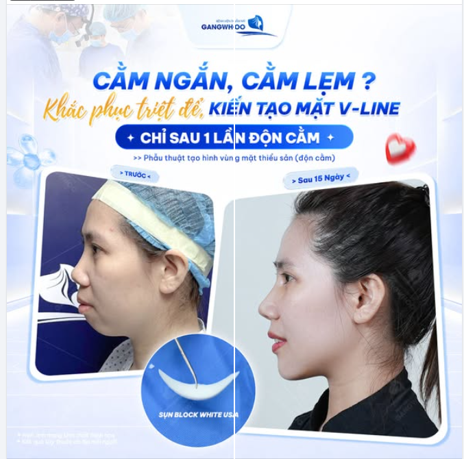 CẰM NGẮN, LẸM KHIẾN TỔNG THỂ GƯƠNG MẶT THIẾU CÂN ĐỐI