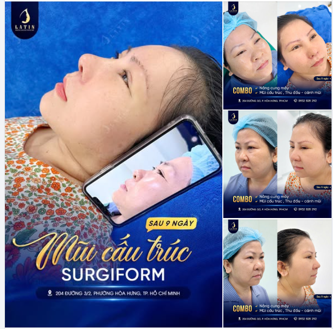 CẢI THIỆN GÓC NGHIÊNG – "TRẺ HÓA" TOÀN BỘ DIỆN MẠO CHỈ SAU 9 NGÀY