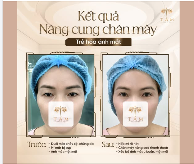 CHÂN MÀY SA TRỄ KHIẾN GƯƠNG MẶT TRÔNG THẾ NÀO?