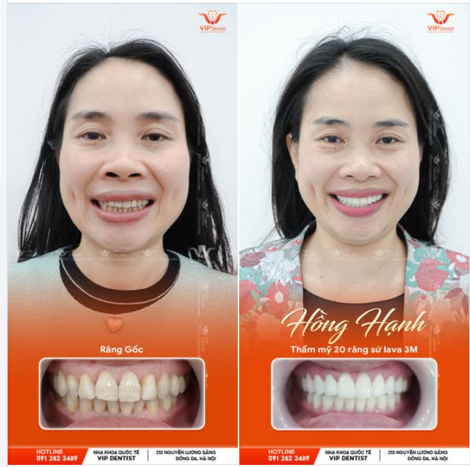BỪNG SÁNG NỤ CƯỜI VỚI 20 RĂNG SỨ LAVA 3M!