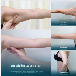 20 NGÀY SAU HÚT MỠ CÁNH TAY – GỌN HƠN VÀ DẤU HÚT RẤT