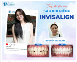 LỘT XÁC NỤ CƯỜI RẠNG RỠ VỚI INVISALIGN: CÂU CHUYỆN CỦA NGUYỄN THỊ HẠNH!