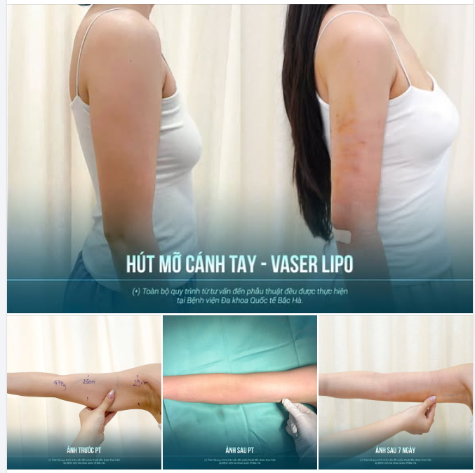 HÚT MỠ CÁNH TAY BAO LÂU THÌ THẤY SỰ THAY ĐỔI?
