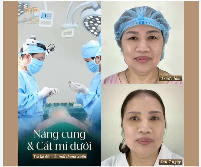 NÂNG CUNG CẮT MÍ DƯỚI - LẤY LẠI TUỔI XUÂN