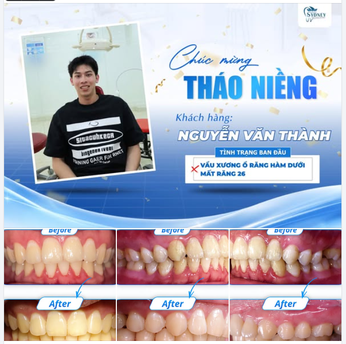 24 THÁNG NIỀNG RĂNG VÀ KẾT QUẢ ĐÁNG TỰ HÀO