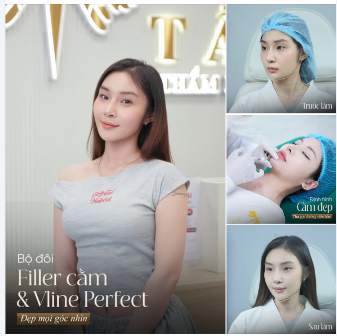 Bộ đôi Filler cằm Vline Perfect - Đẹp mọi góc nhìn
