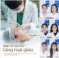 Filler Tái cấu trúc tầng mặt giữa