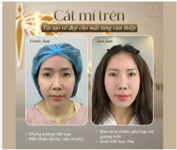 CẮT MÍ TRÊN - TÁI TẠO VẺ ĐẸP CHO MÍ TỪNG CAN THIỆP