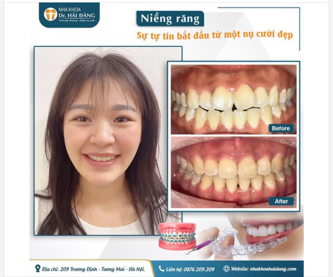 NIỀNG RĂNG – THAY ĐỔI NỤ CƯỜI - THAY ĐỔI CẢ SỰ TỰ TIN