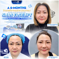 HÀNH TRÌNH THAY ĐỔI DIỆN MẠO SAU 6 THÁNG
