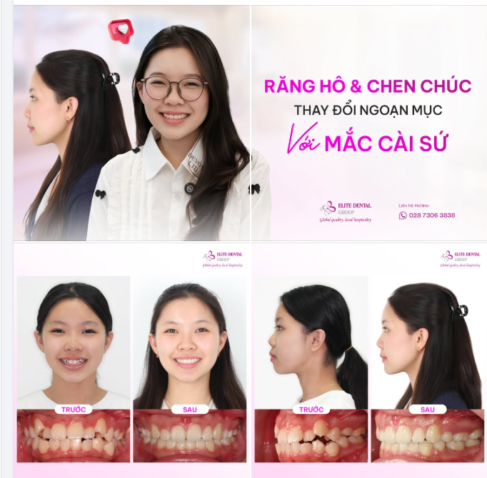 RĂNG HẾT HÔ, HẾT CHEN CHÚC - CÓ THỂ ĐẸP ĐẾN CỠ NÀO?!