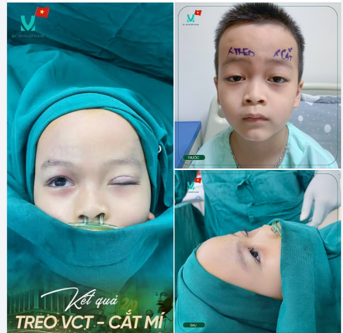 KẾT QUẢ TREO MI VCT KẾT HỢP CẮT MÍ