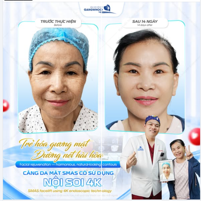 TRẺ HÓA GƯƠNG MẶT - ĐƯỜNG NÉT HÀI HÒA