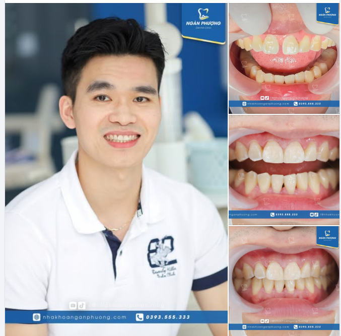 Dán sứ răng cửa, cải thiện răng thưa tuyệt đối điện ảnh