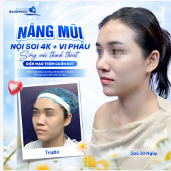 NÂNG MŨI NỘI SOI 4K + VI PHẪU