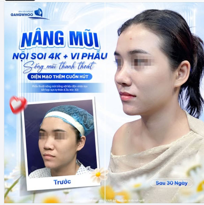 NÂNG MŨI NỘI SOI 4K + VI PHẪU