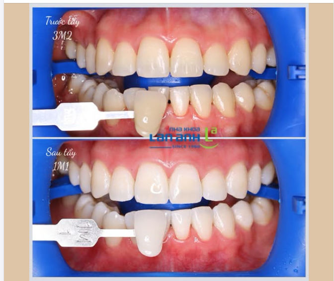 TẨY TRẮNG RĂNG CÓ THỂ LÊN ĐƯỢC MẤY TONE?