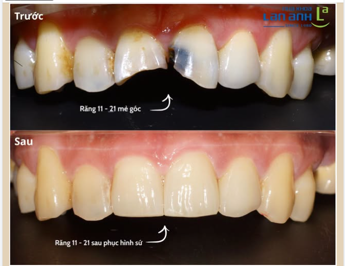 HAI CHIẾC RĂNG CỬA NÀY KHÔNG CHỈ CÓ MỘT VẤN ĐỀ.