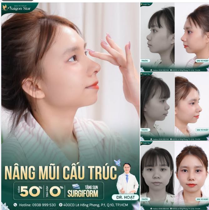 NÂNG MŨI CẤU TRÚC – SẮC NÉT MỌI GÓC NHÌN