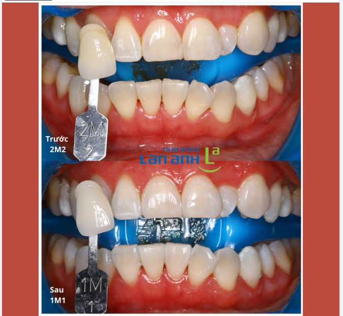 TẨY TRẮNG RĂNG - ĐẸP HƠN NHƯNG VẪN LÀ RĂNG THẬT!