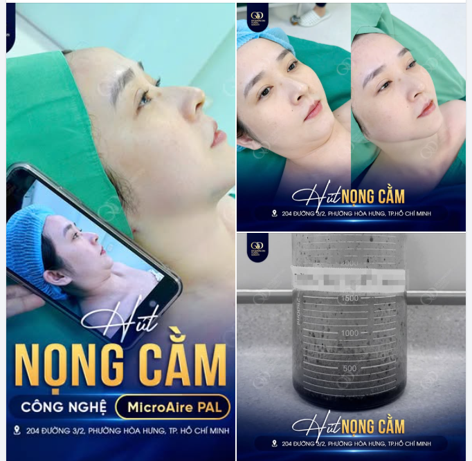 HÚT NỌNG CẰM – DỌN GỌN PHẦN MỠ DƯỚI CẰM, LÀM RÕ ĐƯỜNG NÉT GƯƠNG MẶT
