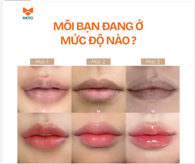 MÔI BẠN ĐANG THÂM Ở MỨC ĐỘ NÀO?